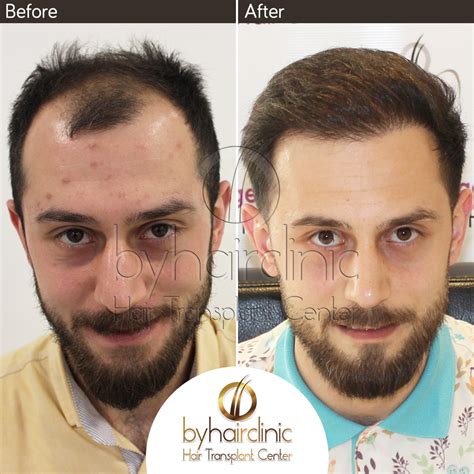 hermes turkey|hair restoration in istanbul turkey.